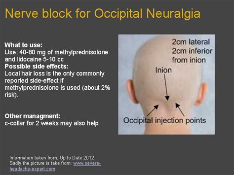 The Add Ed Nerve Block For Occipital Neuralgia