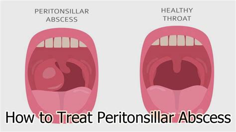 How To Treat Peritonsillar Abscess