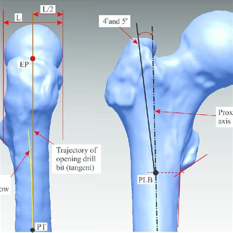 Nail Insertion Entry Points Shown For The Right Femur Lateral Left