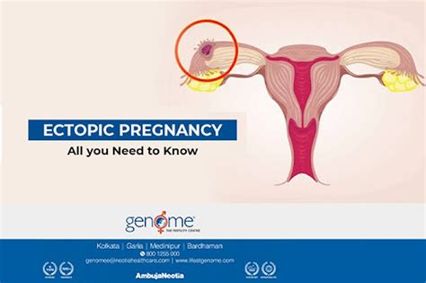 Ectopic Pregnancy All You Need To Know Life At Genome