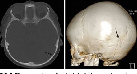 Figure 1 From Pediatric Skull Fracture Diagnosis Should 3d Ct