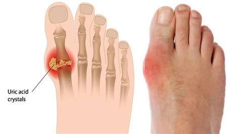 5 Health Problems Associated With Sore Feet Youtube