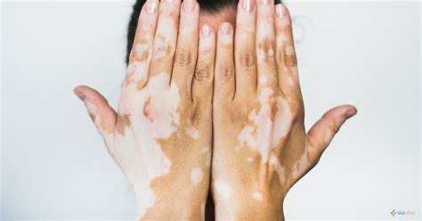 Vitiligo Causes Symptoms Treatment And Diagnosis Skedoc