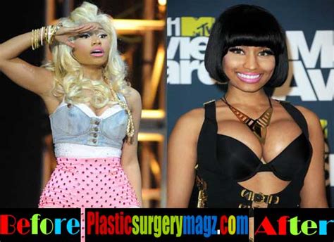 Nicki Minaj Before And After Plastic Surgery Pictures Plastic