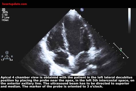 Echocardiography Apical Chamber View AP CH Sonographer Cardiac Ultrasound Probe Chamber