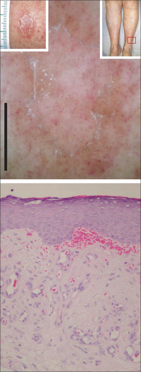 Dermoscopy Of Venous Stasis Dermatitis Dermatology Jama Dermatology