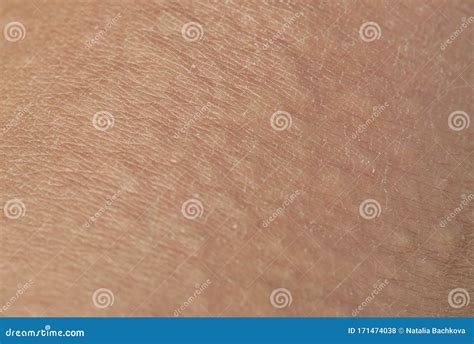 Unhealthy Irritated Skin Texture Covered With Allergic Bumps And