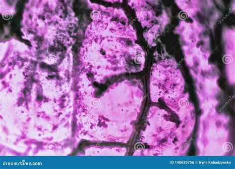 Human Squamous Cell Carcinoma Tissues Affected By Cancer Cells Under A