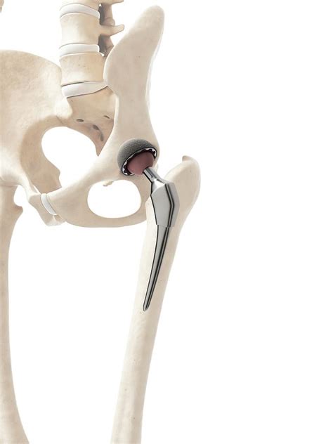 Human Hip Replacement Photograph By Sebastian Kaulitzki