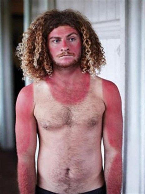 Funny Sunburn Pictures Pics Amusing Sunburn And Tan Lines