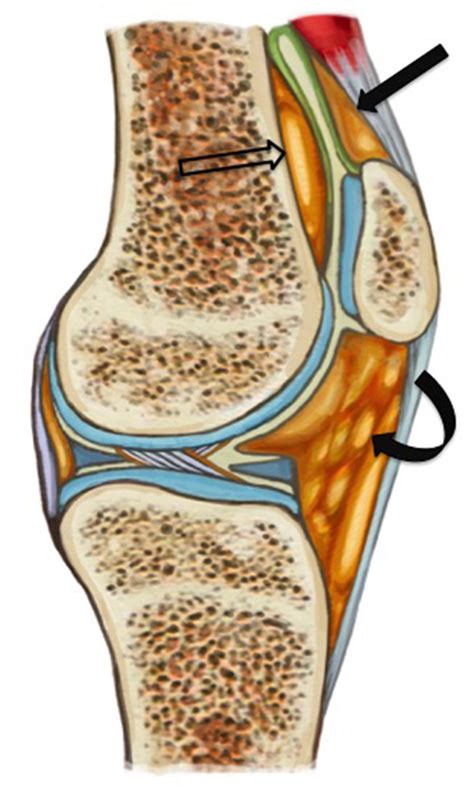 Anatomy Of The Peripatellar Fat Pads The Suprapatellar Fat Pad Solid