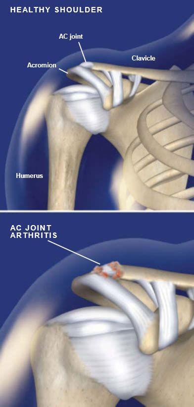 Acromioclavicular Ac Joint Arthritis Central Coast Orthopedic