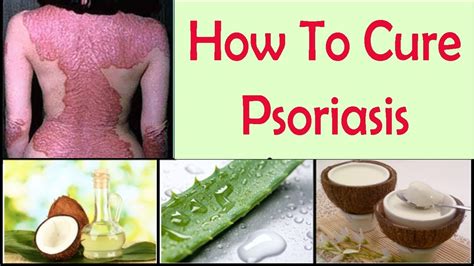 How To Cure Psoriasis Permanently With Natural Home Remedies Youtube