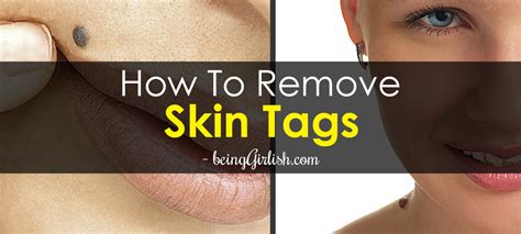 natural home remedies for skin tag removal