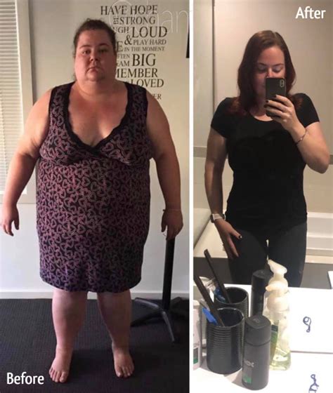 Chantelles Massive Weight Loss After Gastric Sleeve And Skin Removal