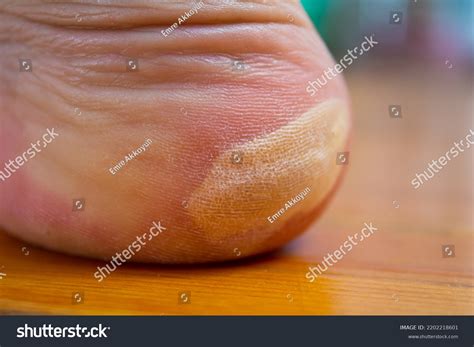 Blister On Foot Foot Injury Concept Stock Photo 2202218601 Shutterstock