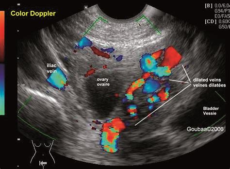 Maybe you would like to learn more about one of these? Comprendre les résultats de votre echographie abdominale ...