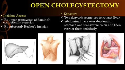 Open Cholecystectomy Operative Surgery