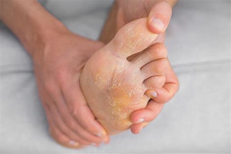 Foot Pain Because Of Strong Flat Feet Also Called Pes Planus Or Fallen