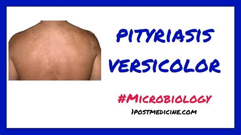 Pityriasis Versicolor Microbiology Youtube