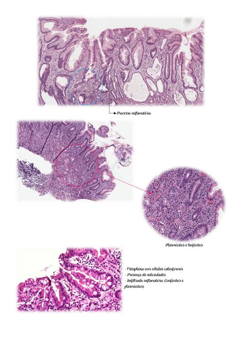 Solution Gastrite Hepatite Coledocol Tiase E Colelit Ase Studypool