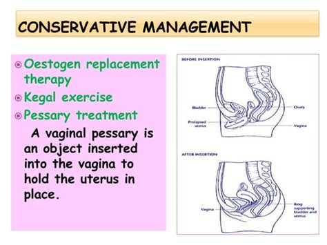 Uterine Displacement