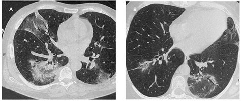 Pneumonia can be generally defined as an infection of the lung parenchyma, in which consolidation of the sections bacterial pneumonia. Patrones de presentación de la neumonía organizada ...