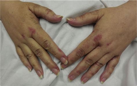 Acrodermatitis Caused By Nutritional Deficiency And Metabolic Disorders