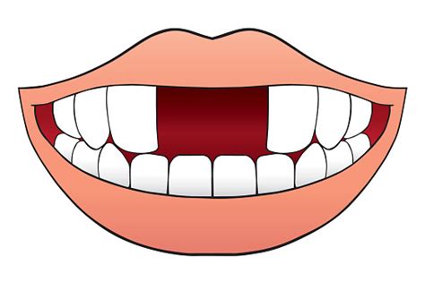 Two Front Teeth Missing Stock Illustration Download Image Now Istock