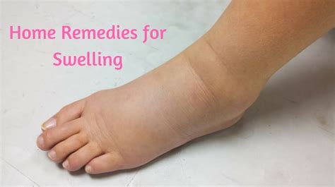 6 Best Home Remedies For Swelling