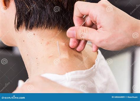 Acupuncturist Pricking Needle Into Skin With Shallow Depth Of F Stock