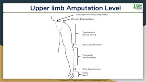 Upper Limb Amputation