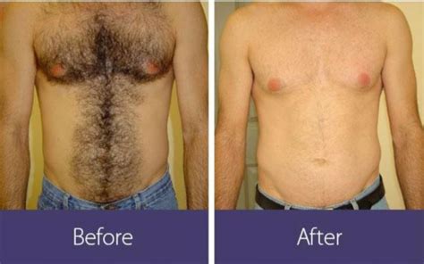 How Much Is Laser Hair Removal Per Treatment Area Boston Laser Hair