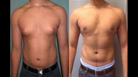 how to get rid of gynecomastia without surgery youtube