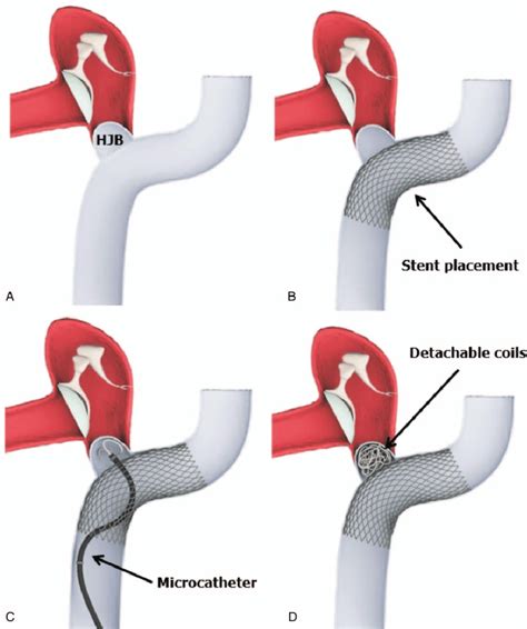 Schematic Illustration Of Transvenous Stent Assisted Coil Embolization