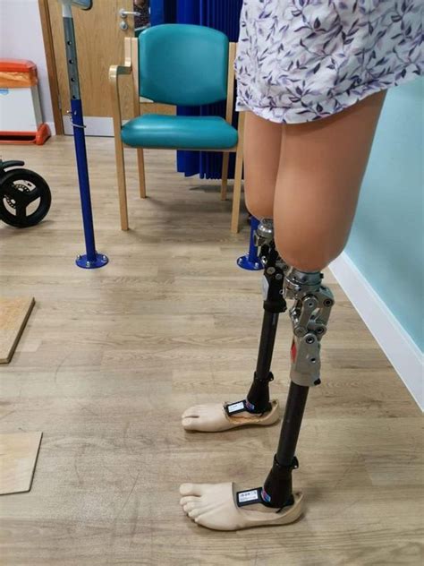 Mum Who Lost Both Legs After Horror House Fire Says It Has Made Her