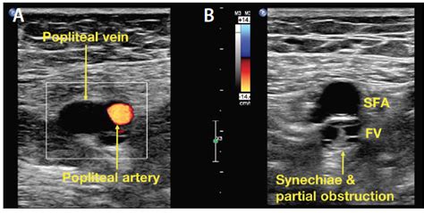 Duplex Ultrasound Technical Considerations For Lower Extremity Venous