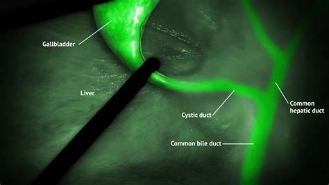 Fluorescence Guided Surgery Colectomy Youtube