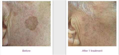 Elos Skin Rejuvenation — Estevan Laser Health Clinic