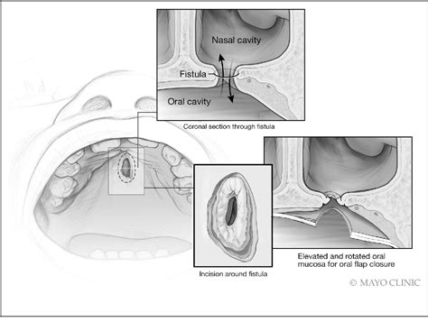 Figure 2 From Triple Layer Oronasal Fistula Repair Using Local
