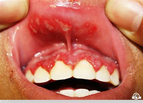 Herpes Simplex Infections