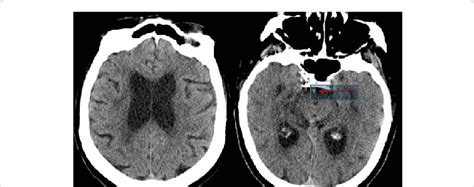 Initial Head Ct No Visible Early Ischemic Changes And Hyperdense Ba