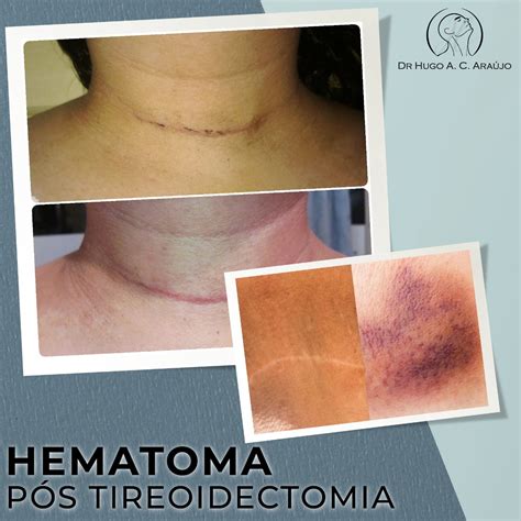 Cirurgia De Otohematoma Pós-operatório