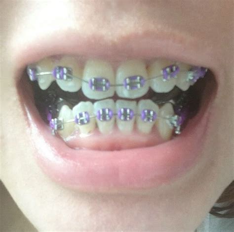 Dark Purple Braces Teeth Braces Ideas Dark Purple Braces Color Braces Purple Braces