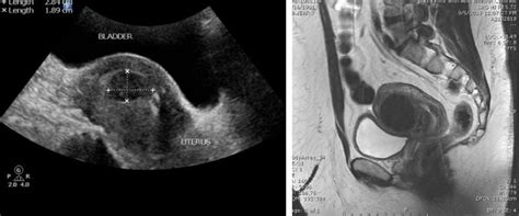 Pelvic Mri And Other Tests To Diagnose Fibroids Fff Foundation