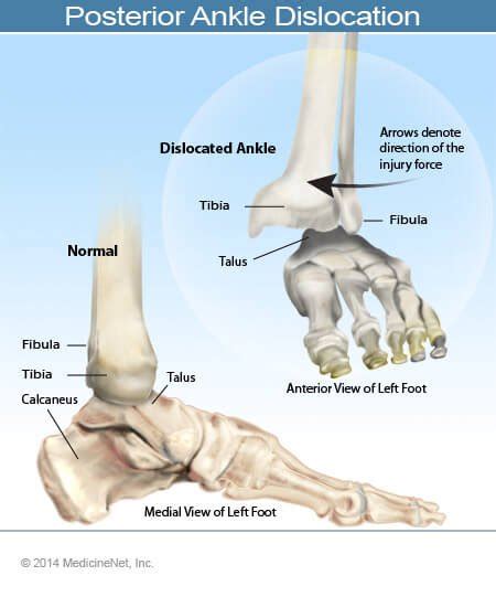 Ankle Dislocations — Maimonides Emergency Medicine Residency