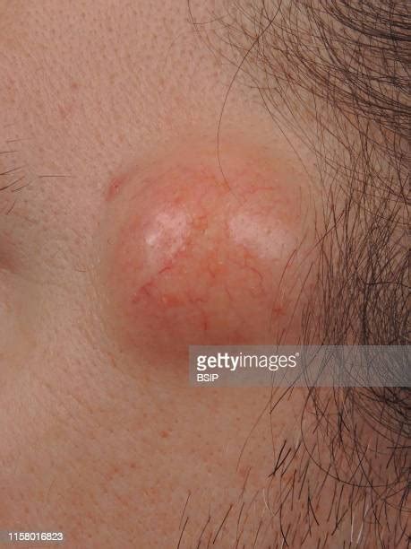 Sebaceous Cyst Photos And Premium High Res Pictures Getty Images