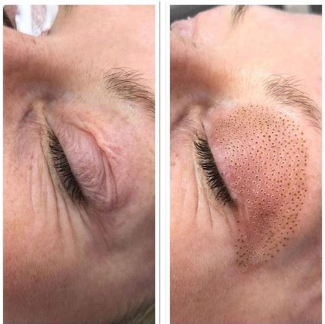 Eyelid Tightening Then Perfect Hairstrokes Permanent