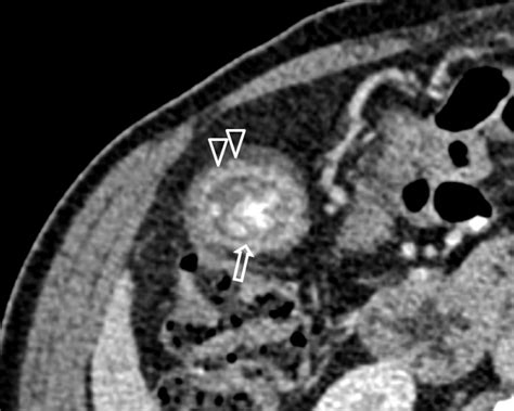Gallbladder Adenomyomatosis Radiology Case Radiogyan