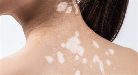 4 Natural Ways For Treating Vitiligo Iskincarereviews